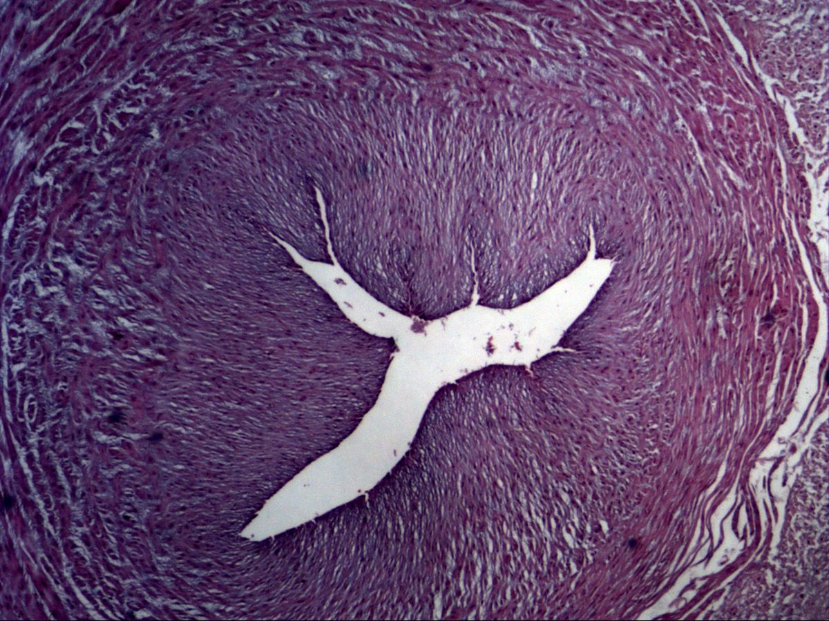 Umbilical artery in cross-section with thick smooth-muscle wall and star-shaped lumen, umbilical cord, H&E