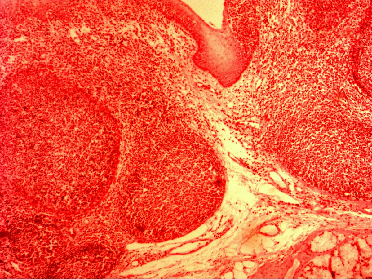 Lymphoid tissue, probably tonsil, with crypt epithelium and glands, H&E, overview